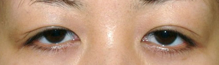 症例5　二重まぶた（切開法）・眼瞼下垂（両側）・目頭切開 手術前