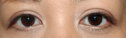 症例5　二重まぶた（切開法）・眼瞼下垂（両側）・目頭切開 手術後