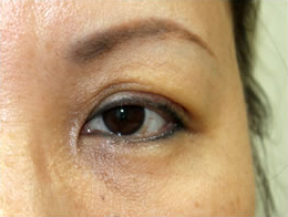 症例27　上眼瞼除皺術の他院修正 手術前