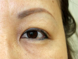 症例27　上眼瞼除皺術の他院修正 手術後