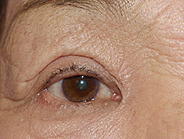 症例28　上眼瞼除皺術の他院修正 手術前
