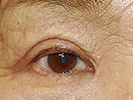症例28　上眼瞼除皺術の他院修正 手術後