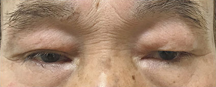 症例29　上眼瞼除皺術＋上まぶた脂肪注入の他院修正 手術前