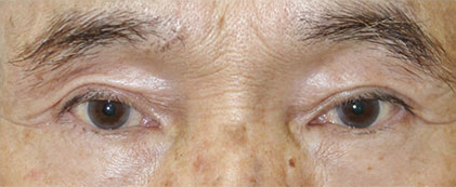 症例29　上眼瞼除皺術＋上まぶた脂肪注入の他院修正 手術後