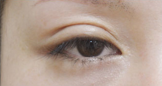 症例31　眼瞼下垂（右）の他院修正 手術前