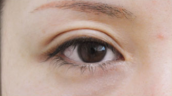 症例31　眼瞼下垂（右）の他院修正 手術後