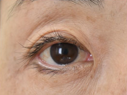 症例32　眼瞼下垂の他院修正 手術前