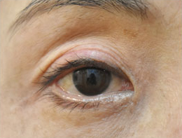 症例32　眼瞼下垂の他院修正 手術後