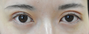 症例25　眼瞼下垂の他院修正 手術前