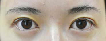 症例25　眼瞼下垂の他院修正 手術後