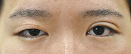 症例37　眼瞼下垂の他院修正 手術前
