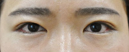症例37　眼瞼下垂の他院修正 手術後