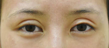 症例38　眼瞼下垂の他院修正 手術前