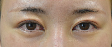 症例38　眼瞼下垂の他院修正 手術後