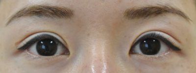 症例39　眼瞼下垂の他院修正 手術前