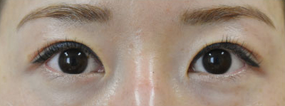 症例39　眼瞼下垂の他院修正 手術後