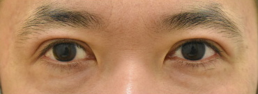 症例4　眼瞼下垂＋二重切開法の他院修正 手術前