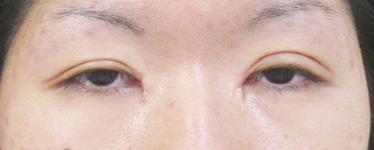 症例40　眼瞼下垂＋目頭切開の他院修正 手術前