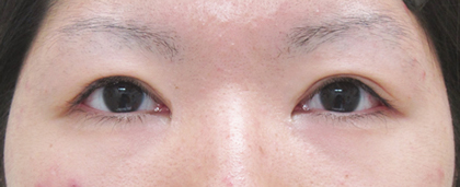 症例40　眼瞼下垂＋目頭切開の他院修正 手術後