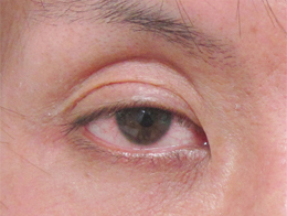 症例41　二重切開法＋目のくぼみの他院修正 手術前