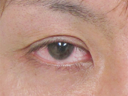 症例41　二重切開法＋目のくぼみの他院修正 手術後
