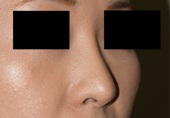 症例6　隆鼻術 手術後
