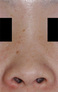 症例9　隆鼻術・鼻翼縮小術 手術前