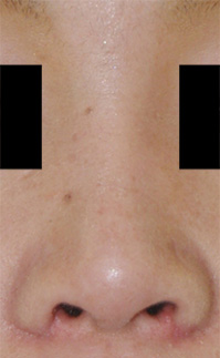 症例9　隆鼻術・鼻翼縮小術 手術後