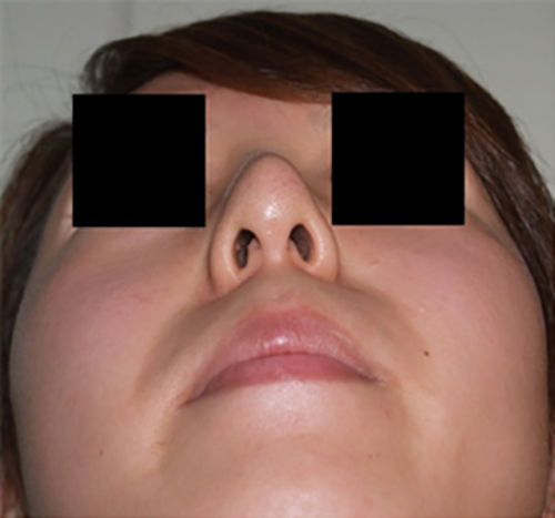 他院での不適切な隆鼻術後の症例・画像