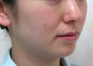症例1　ウルトラセルQプラス（ドットおよびリニア4.5）　頬全体・あご 施術前