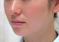 症例1　ウルトラセルQプラス（ドットおよびリニア4.5）　頬全体・あご 施術後
