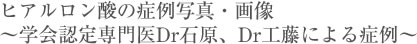 ヒアルロン酸の症例写真・画像 ~学会認定専門医Dr石原、Dr工藤による症例~