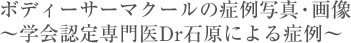 ボディーサーマクールの症例写真・画像 〜学会認定専門医Dr石原による症例〜