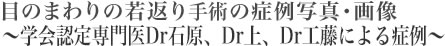 目のまわりの若返り手術の症例写真・画像 〜学会認定専門医Dr石原、Dr上、Dr工藤による症例〜