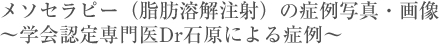 メソセラピー(脂肪溶解注射)の症例写真・画像 〜学会認定専門医Dr石原による症例〜