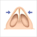 鼻先を細くする手術（鼻尖縮小術）2