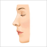 整鼻術（鼻骨削り）2