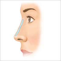 シリコン・プロテーゼによる隆鼻術