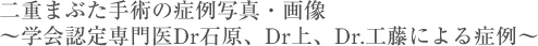 二重まぶた手術の症例 ~学会認定専門医Dr石原、Dr上、Dr工藤による症例~
