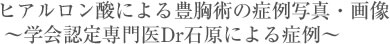 ヒアルロン酸による豊胸術の症例写真・画像〜学会認定専門医Dr石原による症例〜