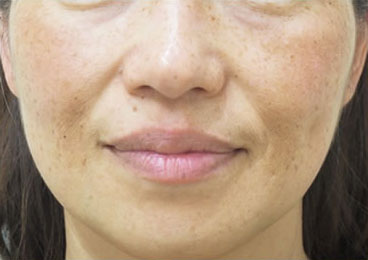 症例1　レーザートーニング（頬の肝斑、そばかす、しみ） 治療前