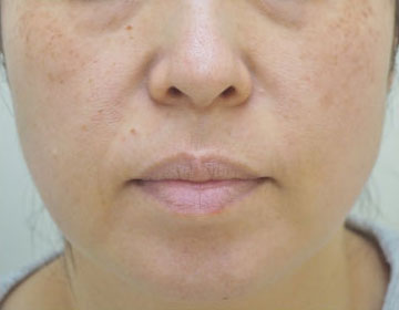 症例2　レーザートーニング（頬の肝斑、しみ、こじわ） 治療前