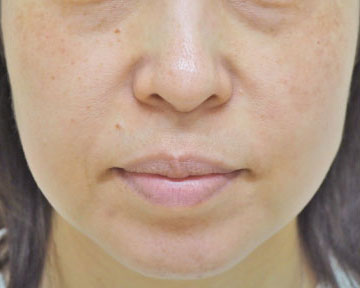 症例2　レーザートーニング（頬の肝斑、しみ、こじわ）治療後