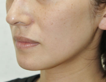 症例3　レーザートーニング（頬のしみ、毛穴） 治療前
