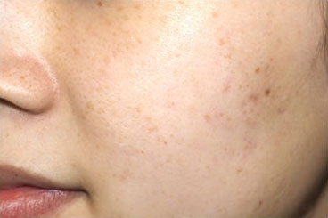 症例4　レーザートーニング（頬全体のそばかす、くすみ） 治療後