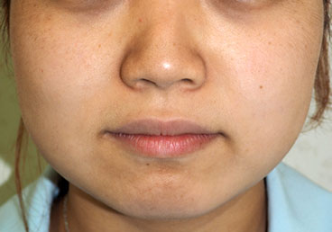 症例5　レーザートーニング（頬全体のくすみ、毛穴の開き） 治療前