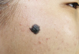 症例15　黒あざ（色素性母斑）切縫法 治療前