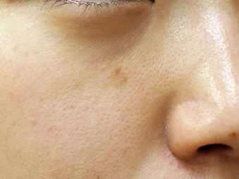 症例10　老人性色素斑（右頬のしみ）レーザー治療 治療前