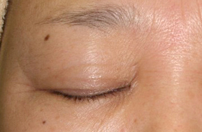 症例2　老人性色素斑（右まぶたのしみ）レーザー治療 治療後