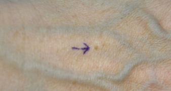 症例6　老人性色素斑（右手の甲のしみ）レーザー治療 治療前